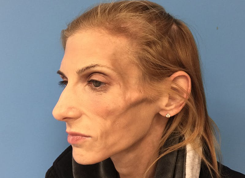 Fillers Before & After Gallery - Patient 112338723 - Image 3