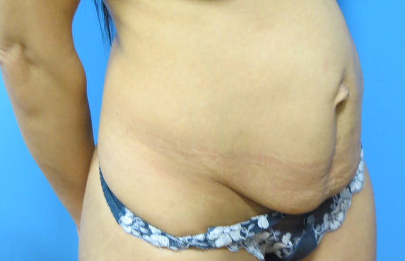 Abdominoplasty Before & After Gallery - Patient 112338722 - Image 7
