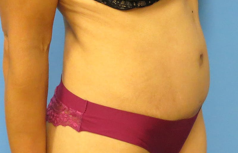 Abdominoplasty Before & After Gallery - Patient 112338722 - Image 8