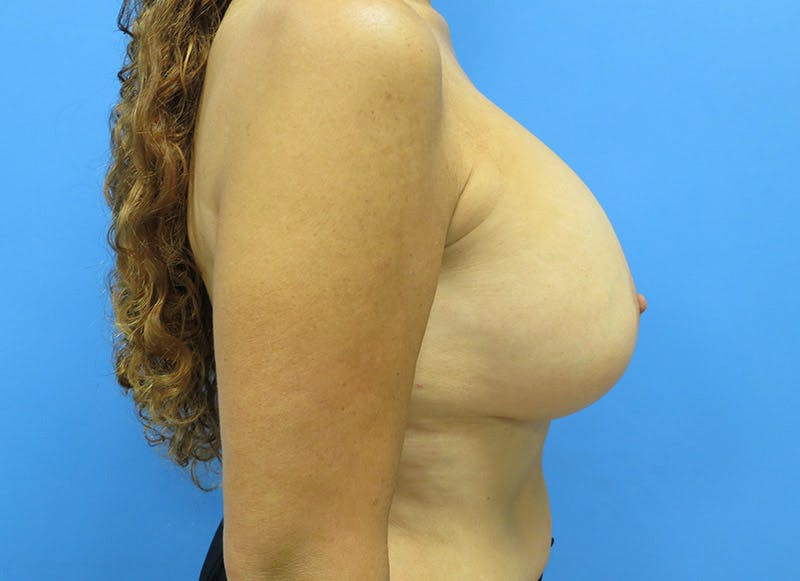 Augmentation Before & After Gallery - Patient 112338721 - Image 9