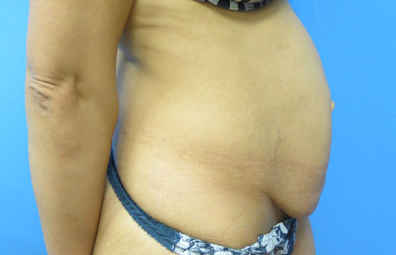 Abdominoplasty Before & After Gallery - Patient 112338722 - Image 9