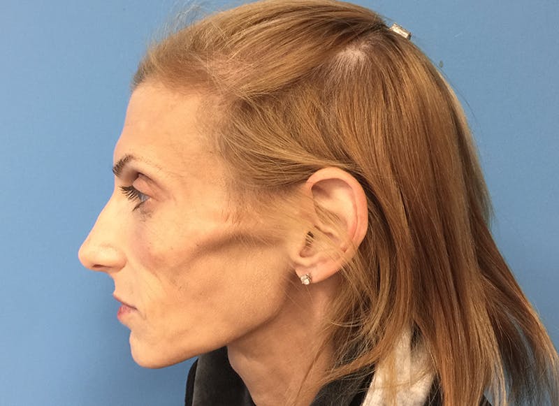 Fillers Before & After Gallery - Patient 112338723 - Image 1