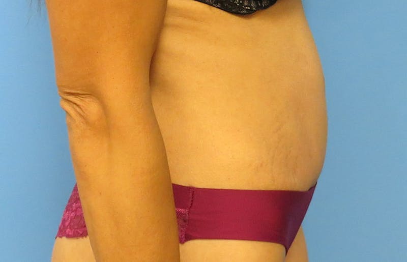 Abdominoplasty Before & After Gallery - Patient 112338722 - Image 10