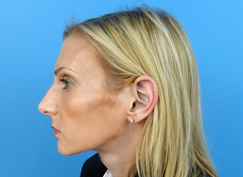 Fillers Before & After Gallery - Patient 112338723 - Image 2