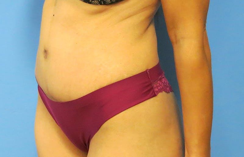 Abdominoplasty Before & After Gallery - Patient 112338722 - Image 4