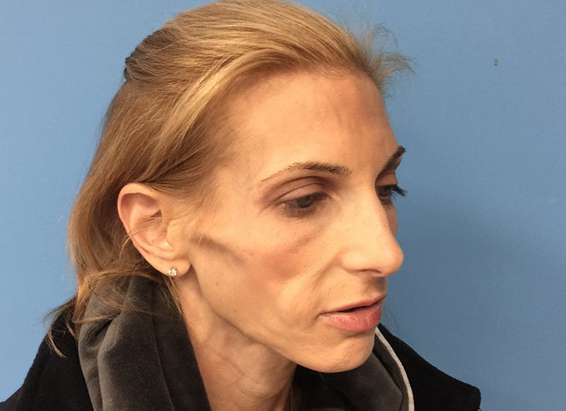 Fillers Before & After Gallery - Patient 112338723 - Image 7
