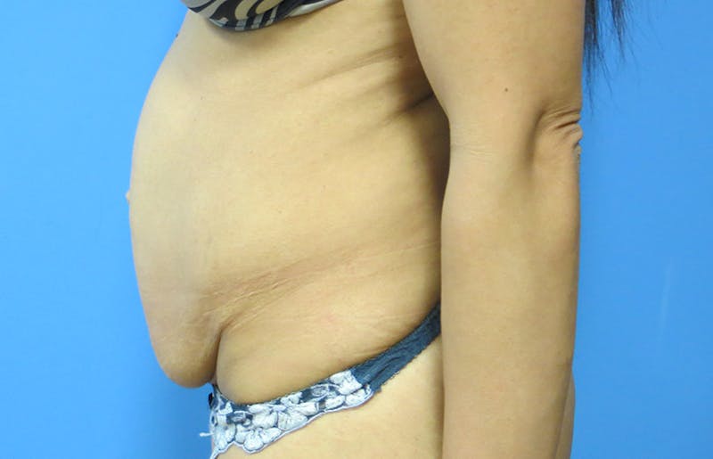 Abdominoplasty Before & After Gallery - Patient 112338722 - Image 1