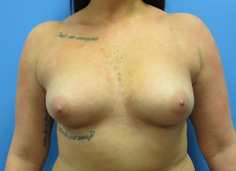 Augmentation Before & After Gallery - Patient 112338725 - Image 5