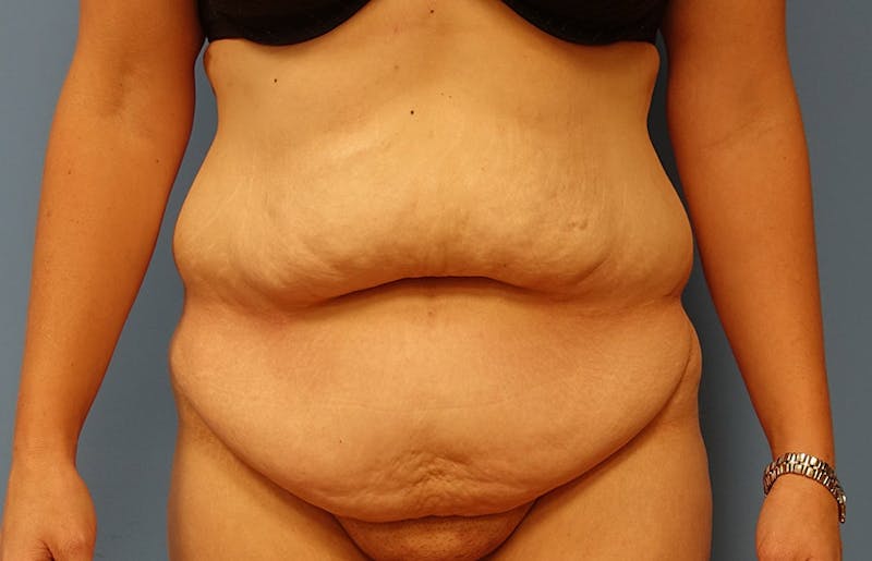 Abdominoplasty Before & After Gallery - Patient 112338726 - Image 5