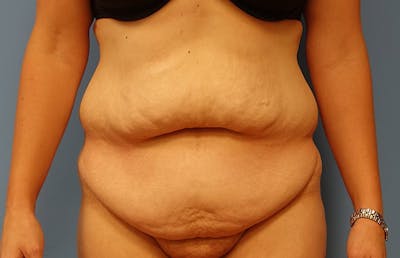 Abdominoplasty Before & After Gallery - Patient 112338726 - Image 5