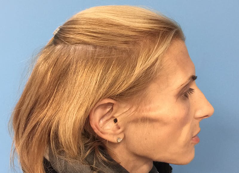 Fillers Before & After Gallery - Patient 112338723 - Image 9