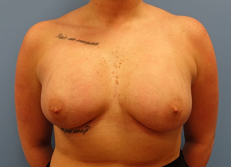 Augmentation Before & After Gallery - Patient 112338725 - Image 6