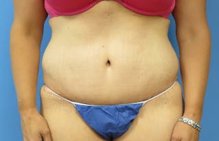 Abdominoplasty Before & After Gallery - Patient 112338726 - Image 6