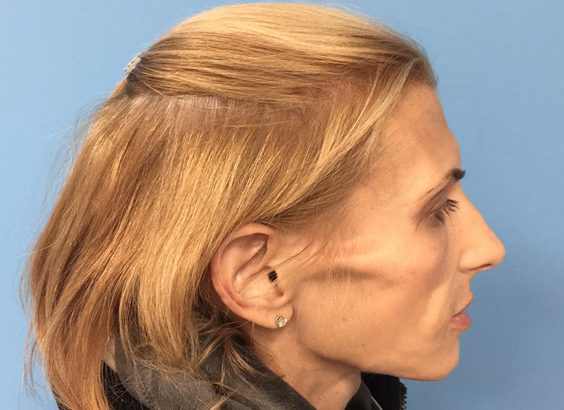 Fillers Before & After Gallery - Patient 112338723 - Image 10
