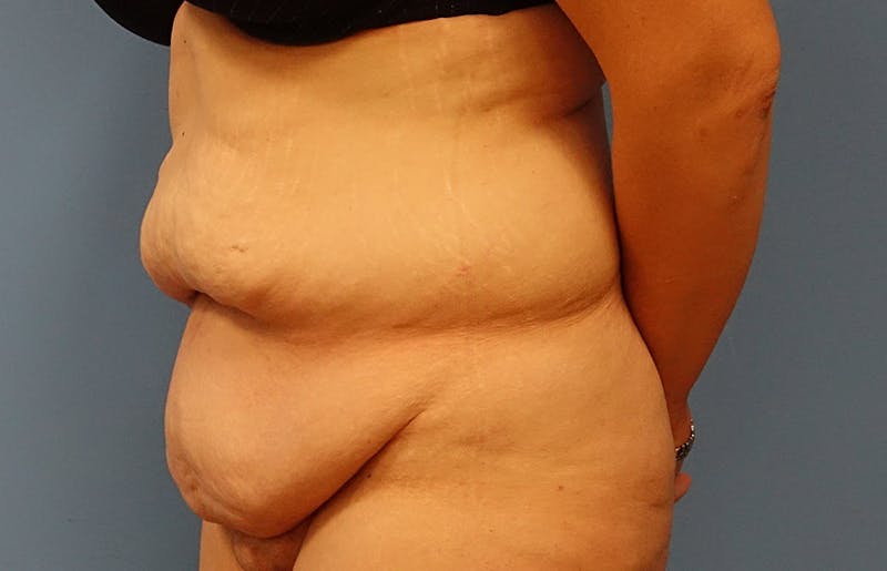 Abdominoplasty Before & After Gallery - Patient 112338726 - Image 3