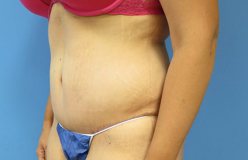 Abdominoplasty Before & After Gallery - Patient 112338726 - Image 4