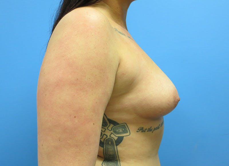 Augmentation Before & After Gallery - Patient 112338725 - Image 9