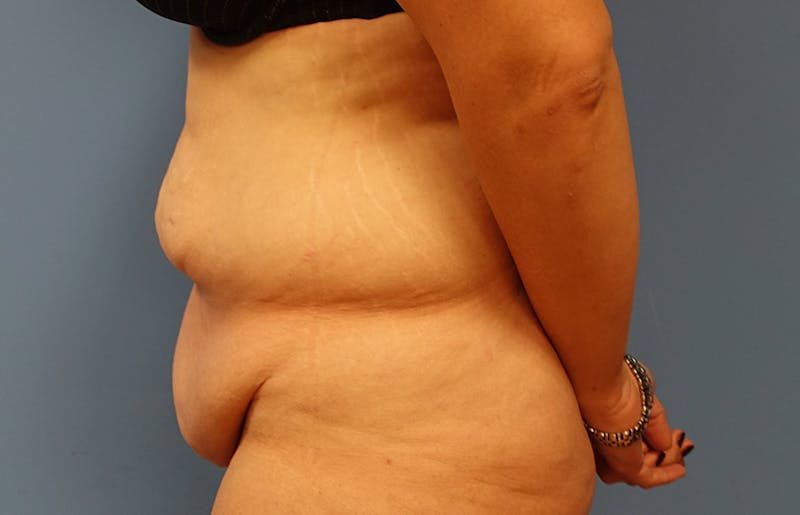 Abdominoplasty Before & After Gallery - Patient 112338726 - Image 1