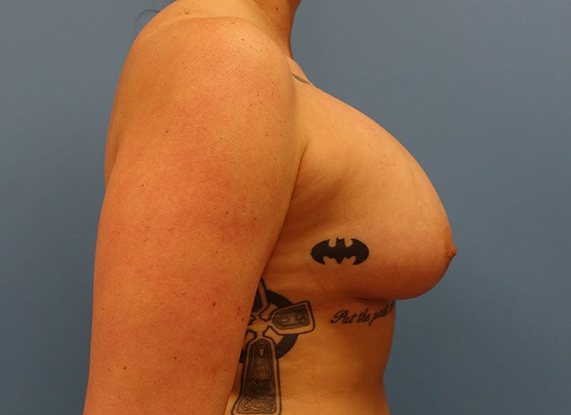 Augmentation Before & After Gallery - Patient 112338725 - Image 10