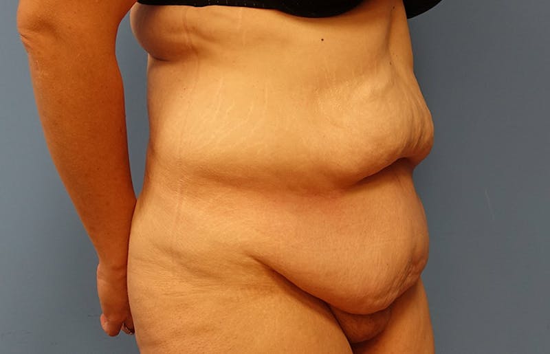 Abdominoplasty Before & After Gallery - Patient 112338726 - Image 7