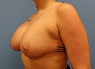 Augmentation Before & After Gallery - Patient 112338725 - Image 4