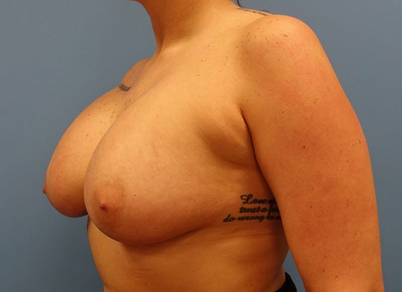 Augmentation Before & After Gallery - Patient 112338725 - Image 4