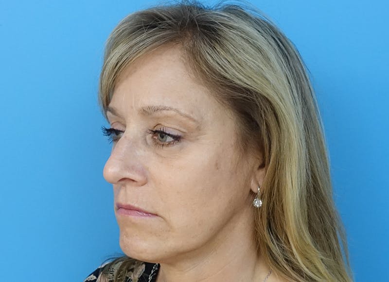 Fillers Before & After Gallery - Patient 112338729 - Image 3