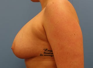 Augmentation Before & After Gallery - Patient 112338725 - Image 2
