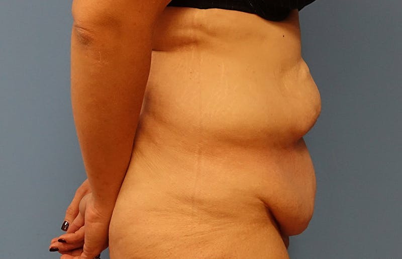 Abdominoplasty Before & After Gallery - Patient 112338726 - Image 9