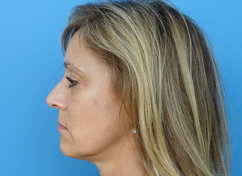 Fillers Before & After Gallery - Patient 112338729 - Image 1