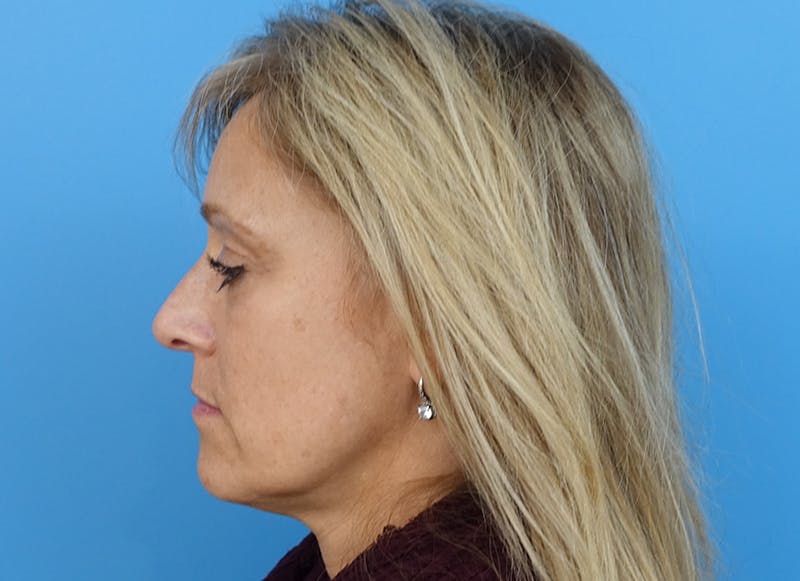 Fillers Before & After Gallery - Patient 112338729 - Image 2