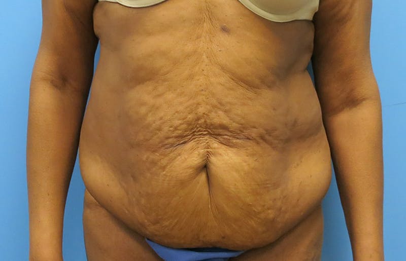 Abdominoplasty Before & After Gallery - Patient 112338731 - Image 5