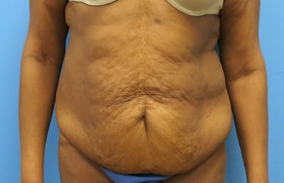 Abdominoplasty Before & After Gallery - Patient 112338731 - Image 5
