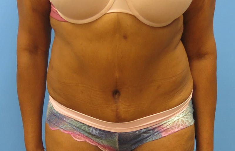 Abdominoplasty Before & After Gallery - Patient 112338731 - Image 6