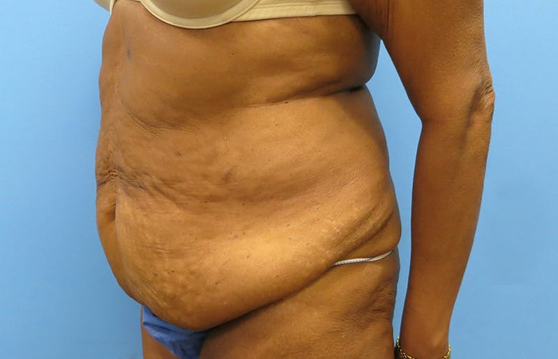 Abdominoplasty Before & After Gallery - Patient 112338731 - Image 3