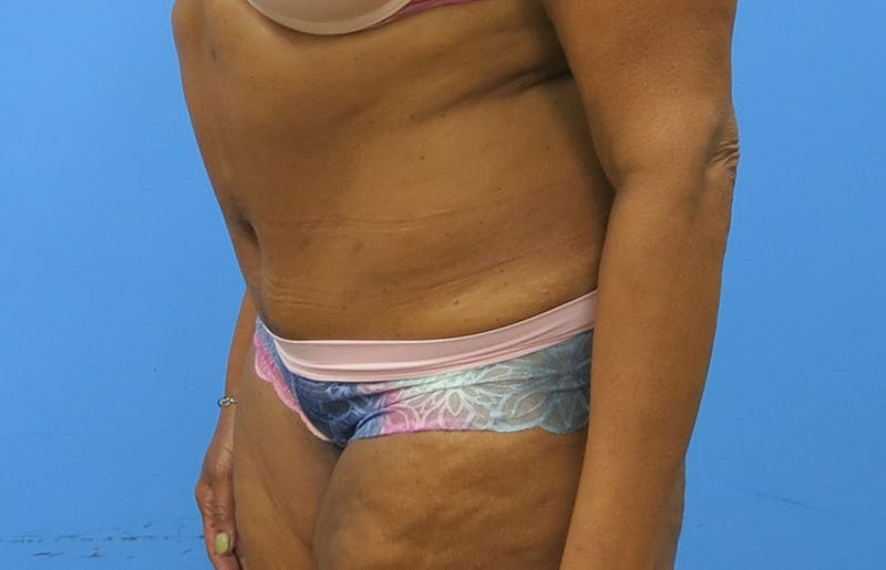 Abdominoplasty Before & After Gallery - Patient 112338731 - Image 4