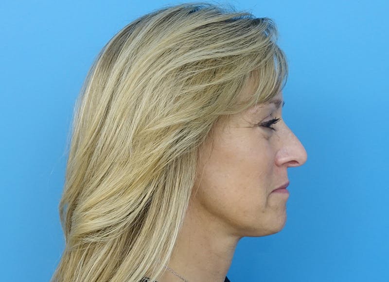 Fillers Before & After Gallery - Patient 112338729 - Image 9