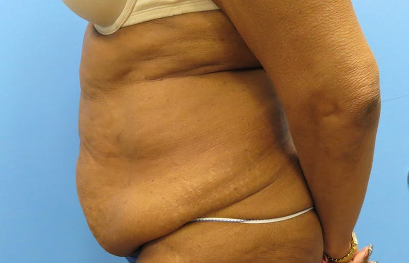 Abdominoplasty Before & After Gallery - Patient 112338731 - Image 1