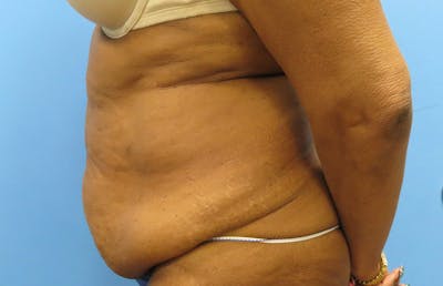 Abdominoplasty Before & After Gallery - Patient 112338731 - Image 1