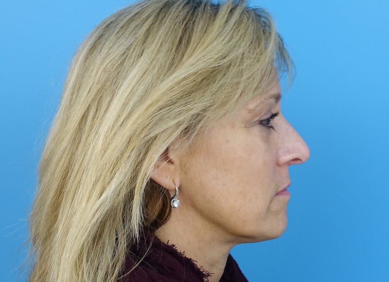 Fillers Before & After Gallery - Patient 112338729 - Image 10