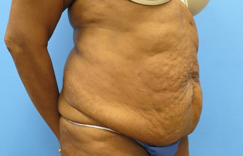 Abdominoplasty Before & After Gallery - Patient 112338731 - Image 7