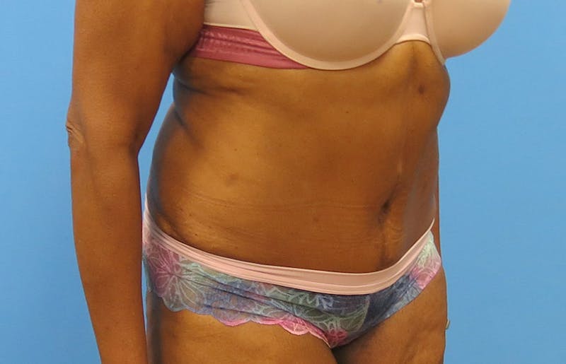 Abdominoplasty Before & After Gallery - Patient 112338731 - Image 8