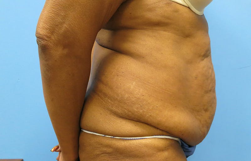 Abdominoplasty Before & After Gallery - Patient 112338731 - Image 9
