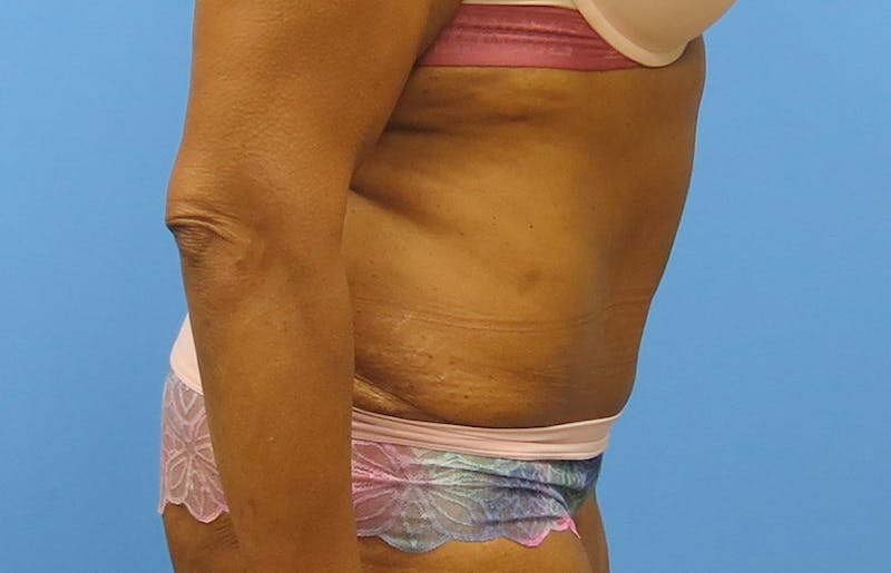 Abdominoplasty Before & After Gallery - Patient 112338731 - Image 10