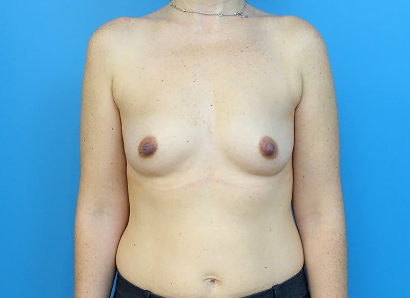 Augmentation Before & After Gallery - Patient 112338734 - Image 5