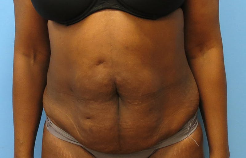 Abdominoplasty Before & After Gallery - Patient 112338733 - Image 5