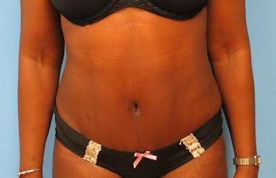 Abdominoplasty Before & After Gallery - Patient 112338733 - Image 6