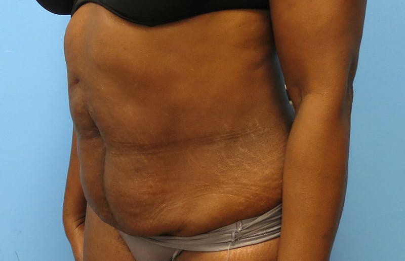 Abdominoplasty Before & After Gallery - Patient 112338733 - Image 3
