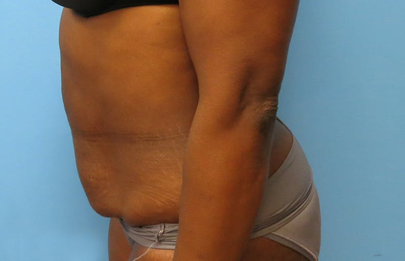 Abdominoplasty Before & After Gallery - Patient 112338733 - Image 1