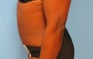 Abdominoplasty Before & After Gallery - Patient 112338733 - Image 2
